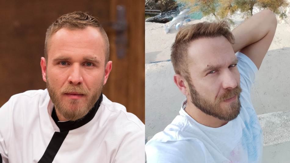 Ivan Pažanin nakon presađivanja kose