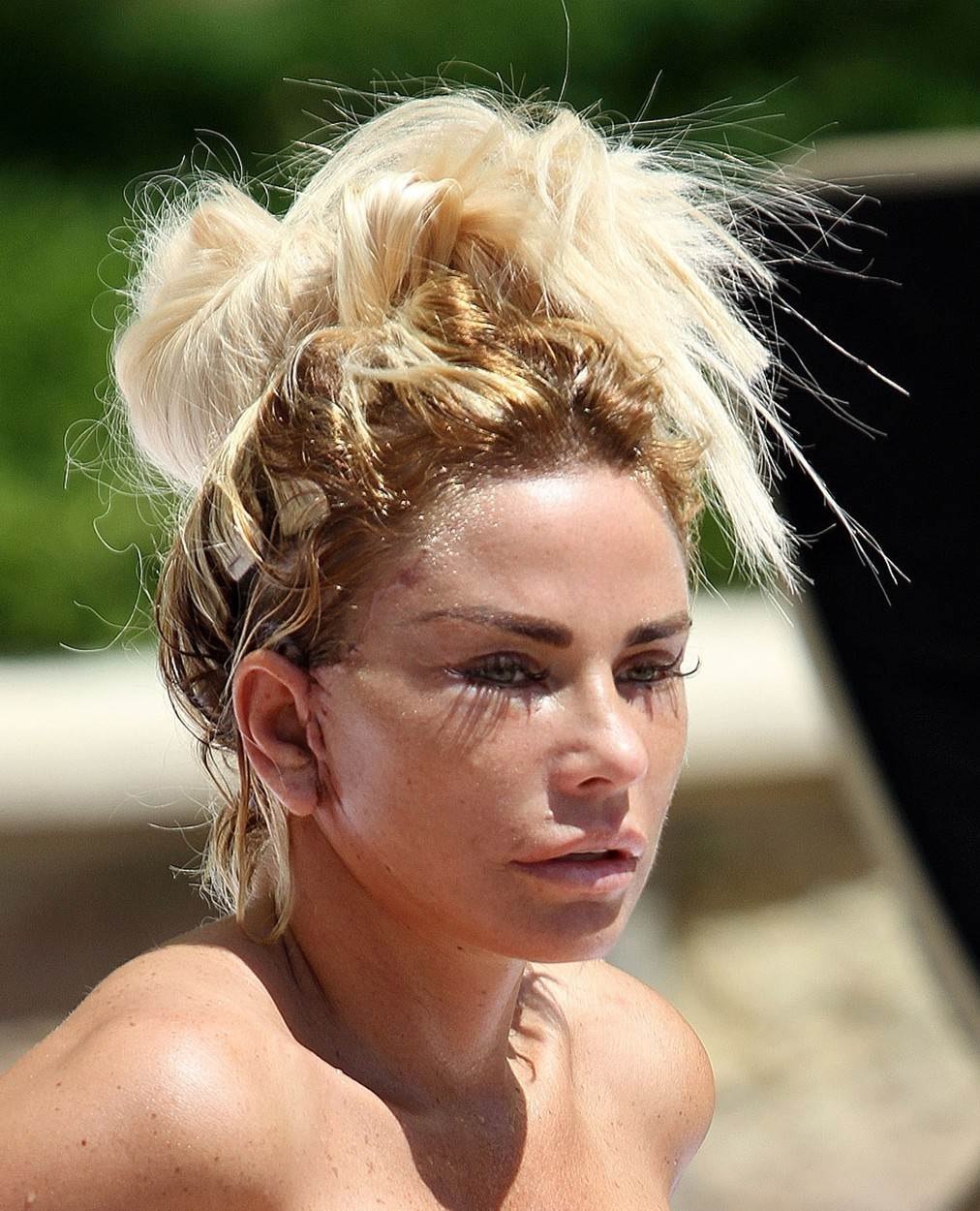 Lice Katie Price se raspada zbog operacija